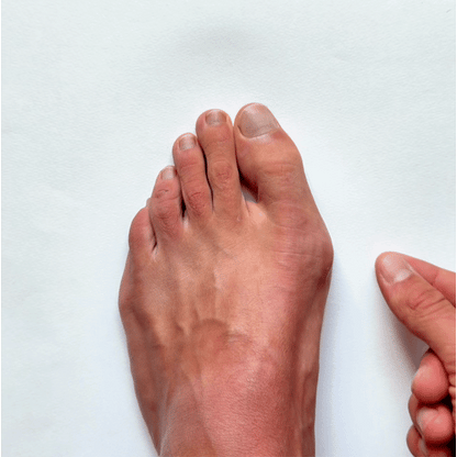 Cinta correctora para hallux valgus Nuvergo™