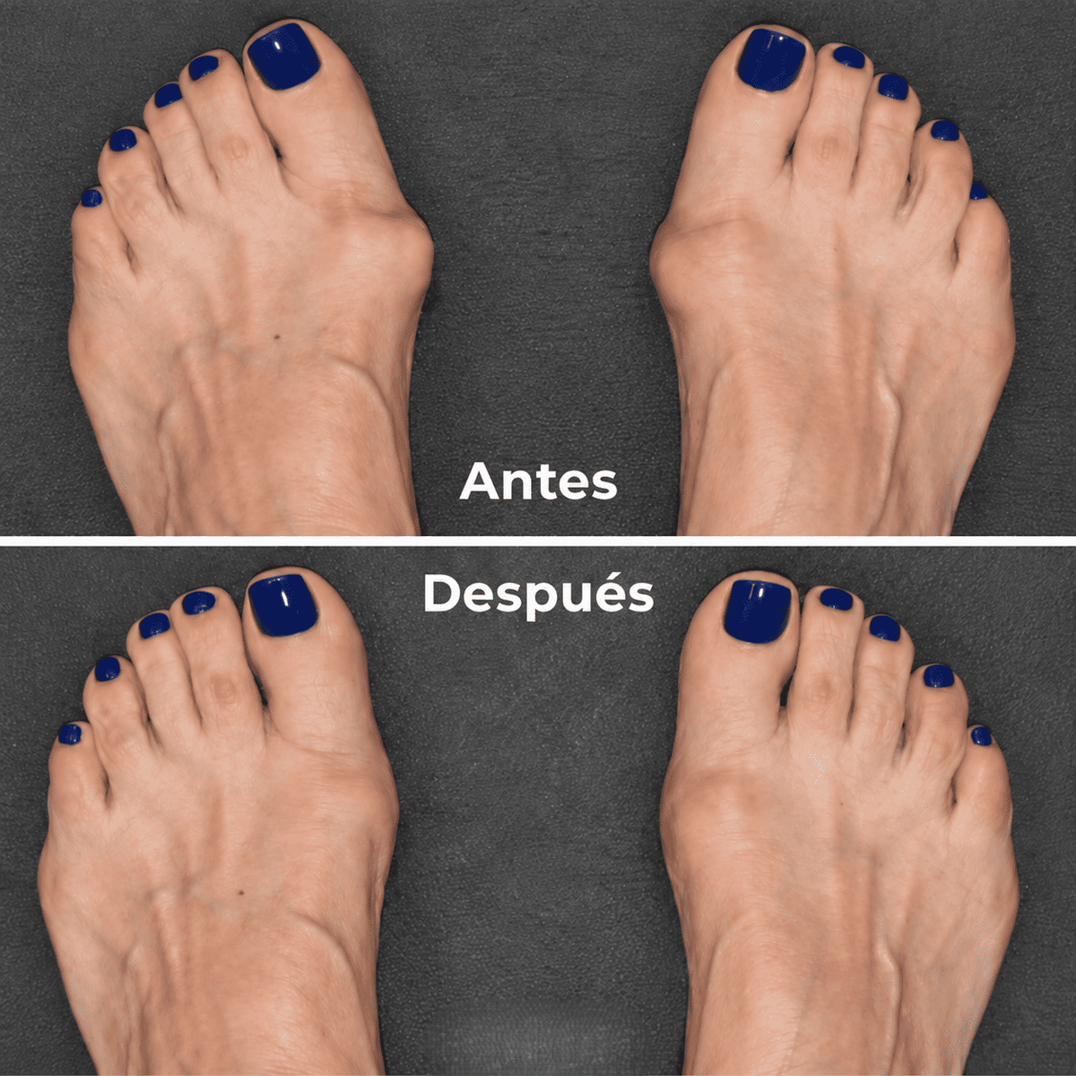 Cinta correctora para hallux valgus Nuvergo™
